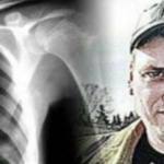 fenyőfa tüdő férfi sebészek furcsa rák