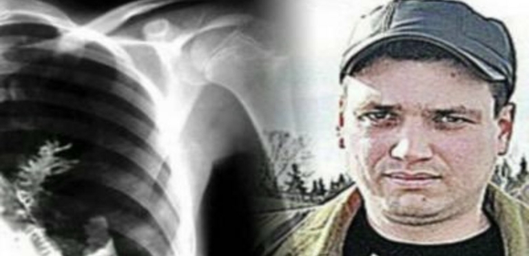 fenyőfa tüdő férfi sebészek furcsa rák