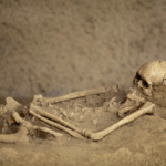 trepanáció