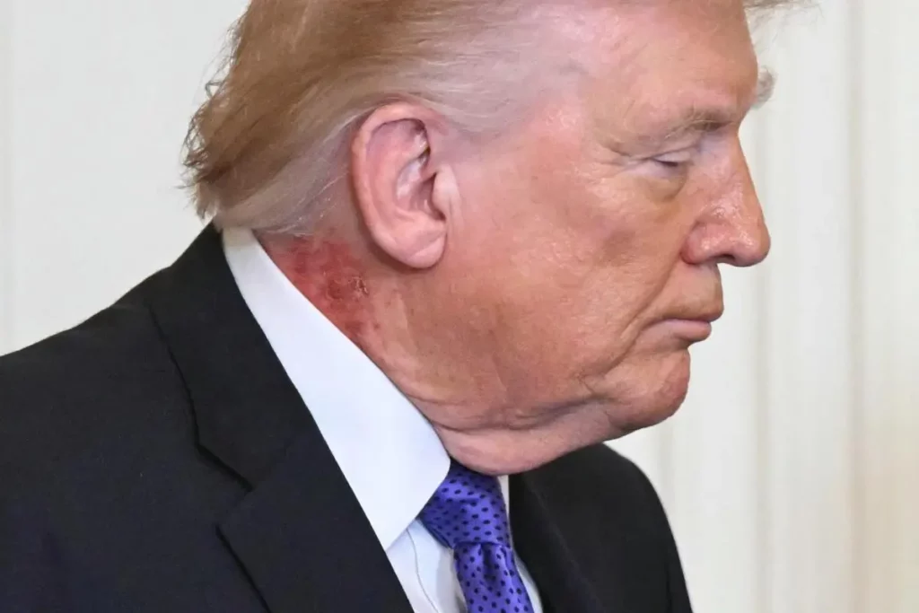 Donald Trump nyak betegség Fehér ház